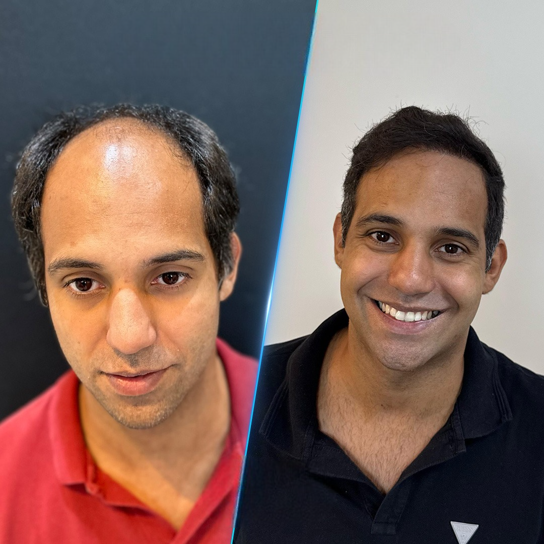 Vorher-Nachher Haartransplantation